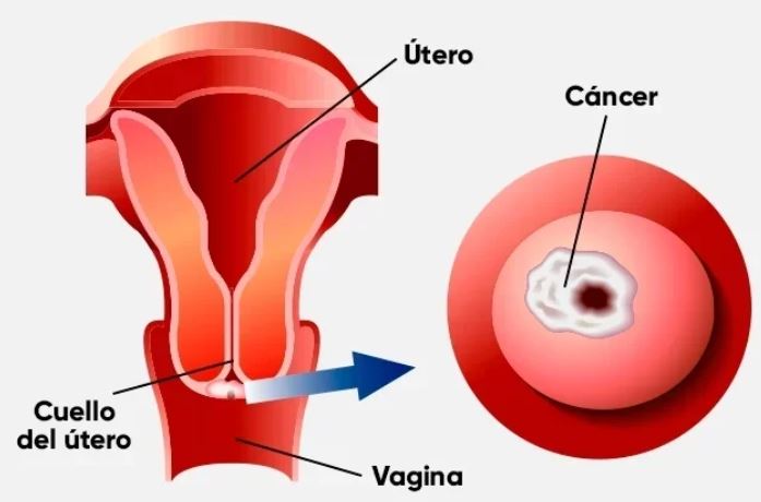cáncer de cuello uterino